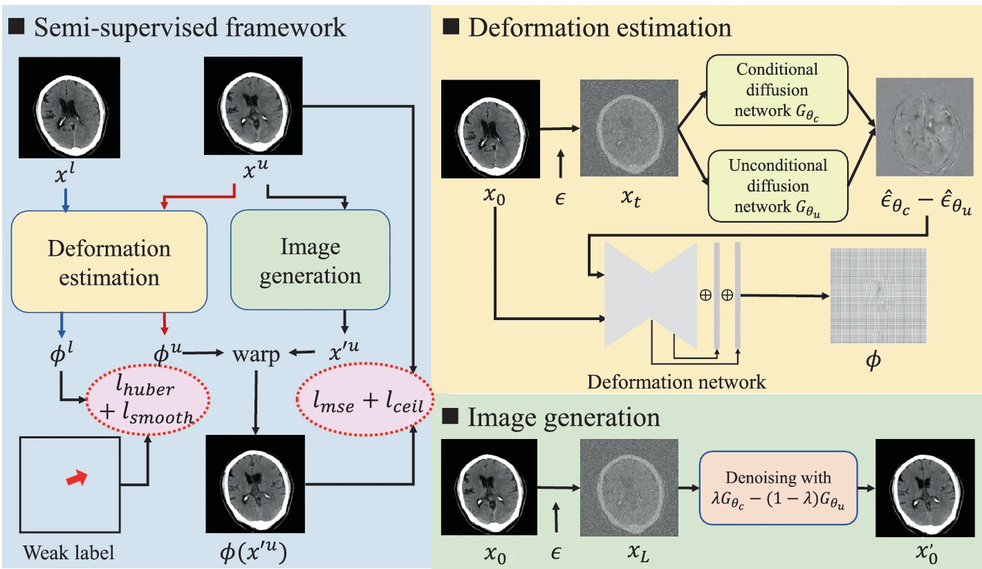 Diffusion Model based Semi-supervised Learning on Brain Hemorrhage Images for Efficient Midline Shift Quantification